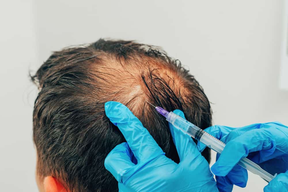  Mesotherapie der Kopfhaut