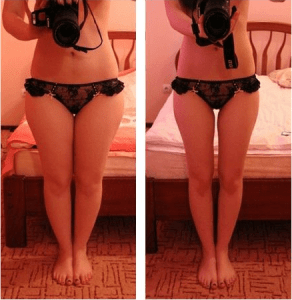  Frau vor und nach der Gewichtsabnahme