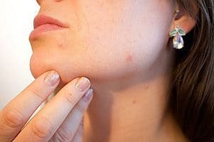  kvinde med acne-pronende hud