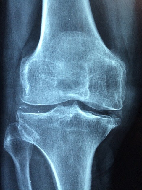  røntgenbillede af knæleddet