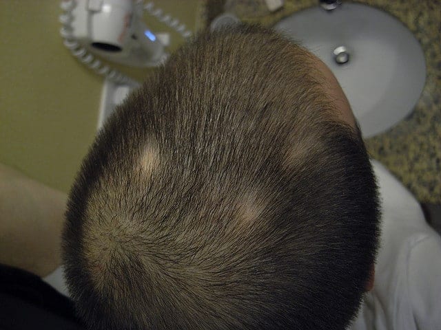  alopeetsia areata