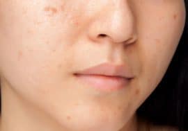  acné sur le visage