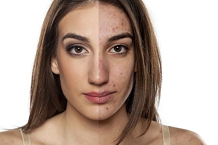  une femme à la peau saine et sujette à l'acné