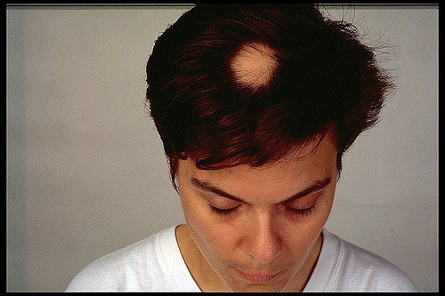  areatinė alopecija