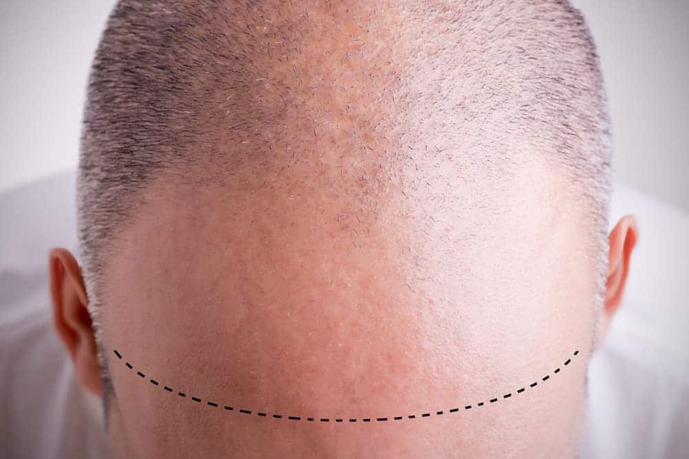  vyrų androgeninė alopecija