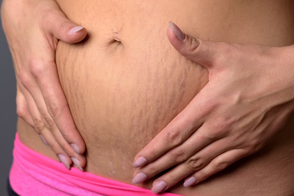  Zwangerschapsstriemen op de buik