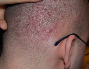  acne van de hoofdhuid