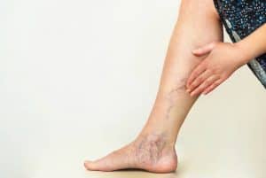 varizes de perna