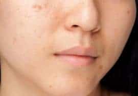  acne na cara