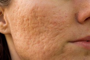  acne benägen hud