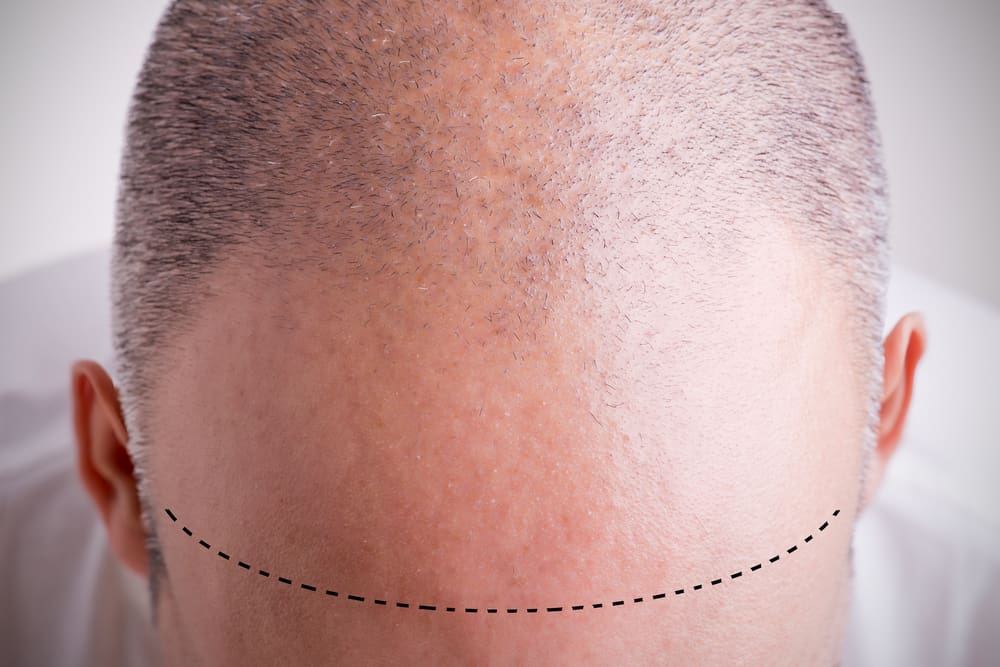  moška androgena alopecija