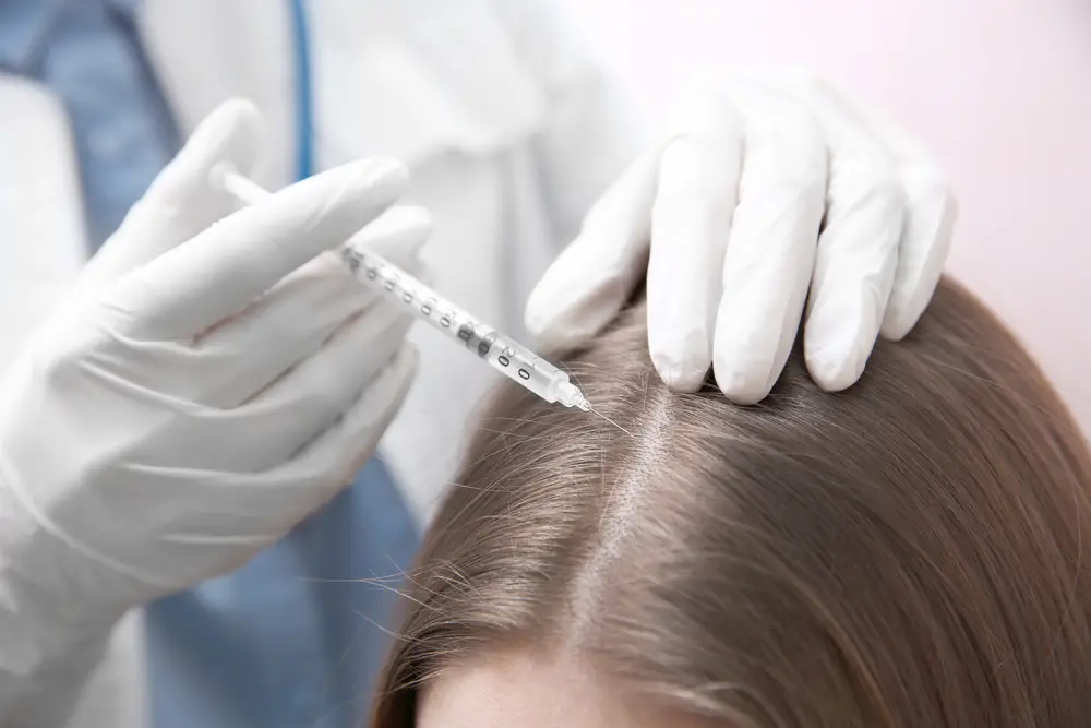  needle mesotherapy of the scalp