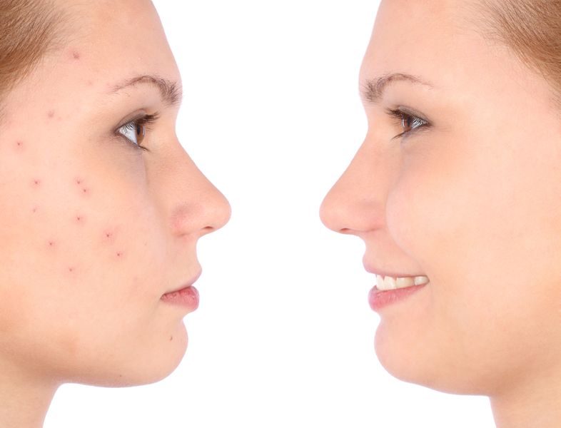  a woman with and without acne