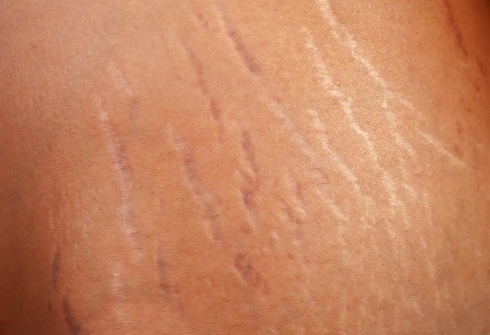  Skin with stretch marks